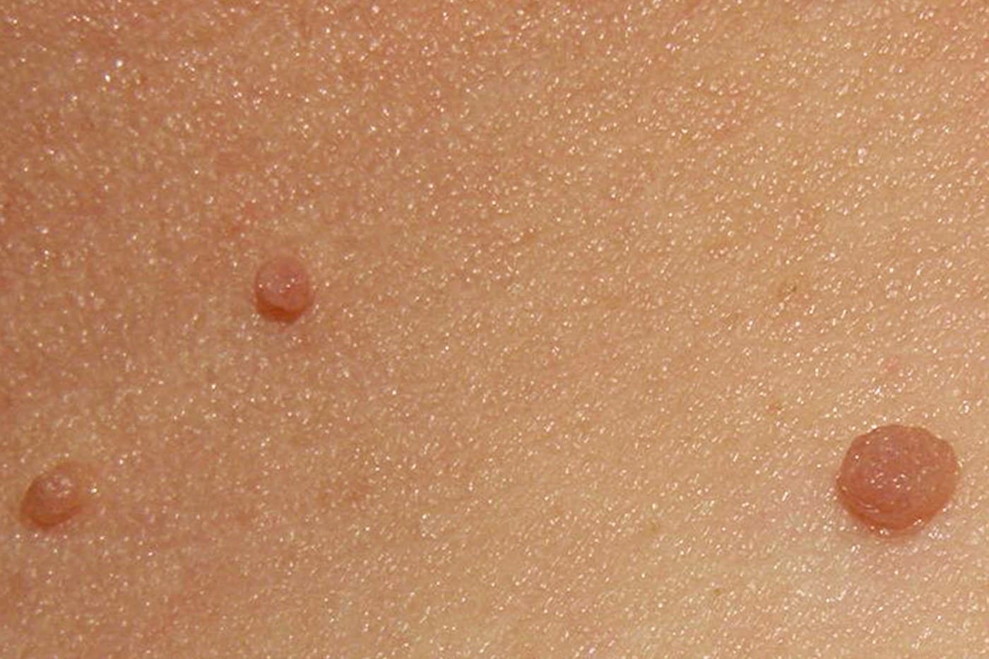 Minkštosios fibromos (odos karpelės) ant kaklo odos