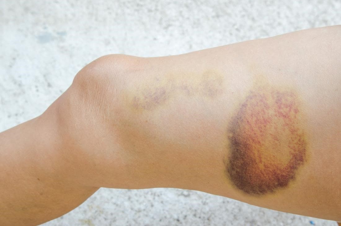 Odos hematomos diagnostika Geltonai violetinė hematoma ant kojos prie kelio – sumušimo sukeltas kraujosruvos pavyzdys.